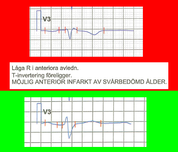 EKG-tolkning